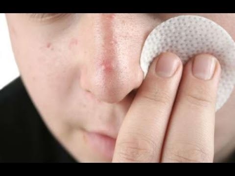 How To Avoid Pimples On The Face